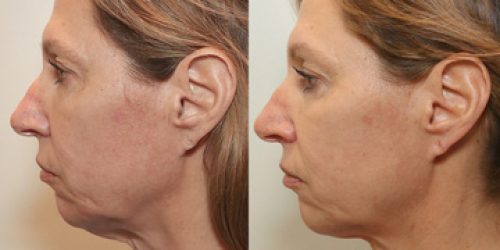 M8FaceTite_Before&After