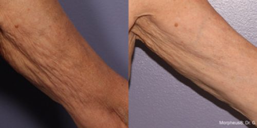 Morpheus8 Before & After (1)