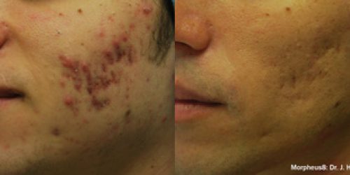 Morpheus8 Before & After (2)