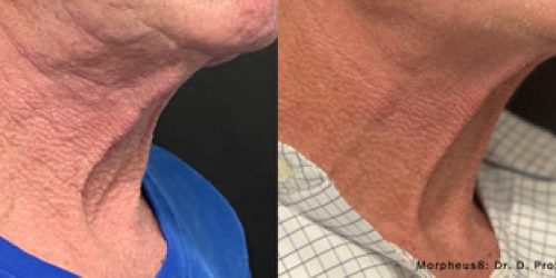 Morpheus8 Before & After