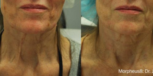 Morpheus8_Before&After